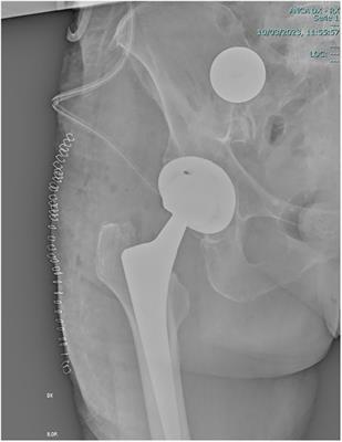 Transperitoneal laparoscopic retrievement of a migrated prosthetic head after total hip arthroplasty: a case report